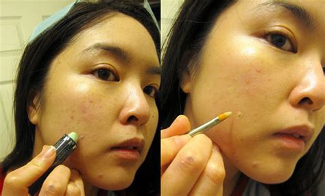 How To Cover Pimples And Scars With A Combination Of