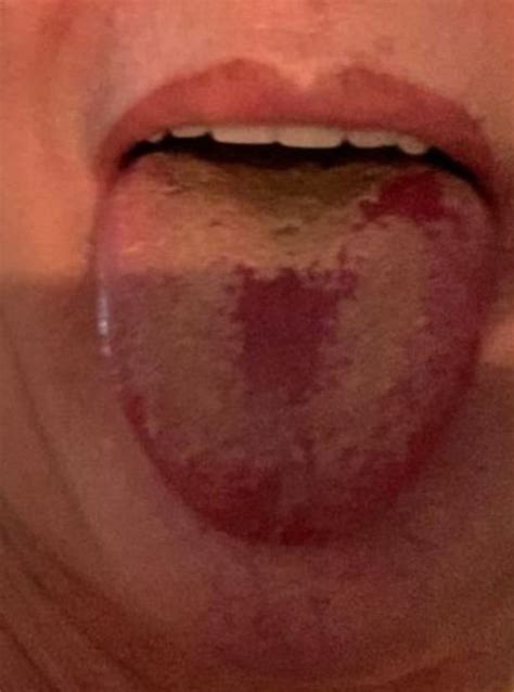 Covid Tongue Becoming More Widespread As Coronavirus Symptom Metro News