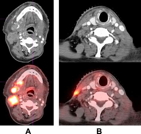 Cervical Nodal Metastasis In Head And Neck Cancer A Clinical Conundrum