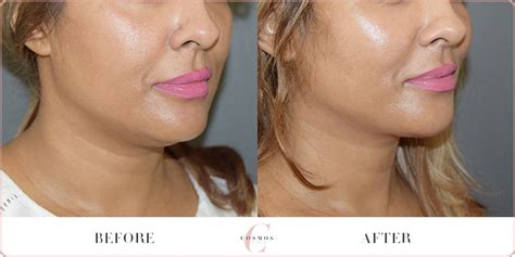 Silhouette Soft Face Lift Before And After
