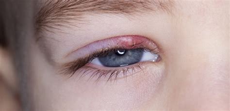 Stye On Eyelid Pictures Causes How To Get Rid Treatment