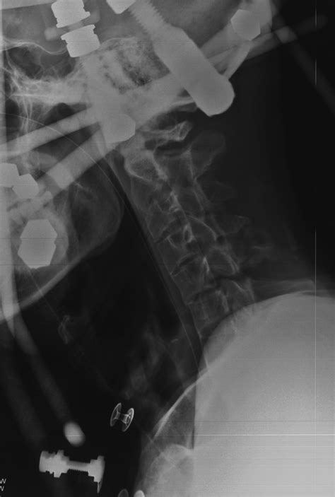 Reduction Of Cervical Fractures In Patients With As From The