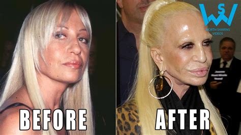 Madonna Plastic Surgery Before After Telegraph