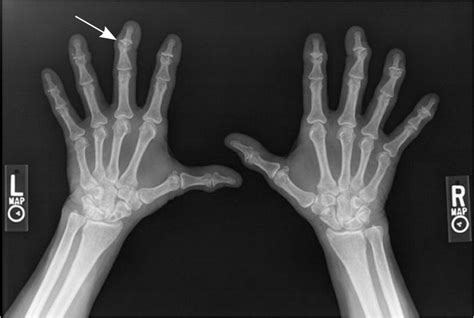 Painless Nodules In The Fingers AAFP