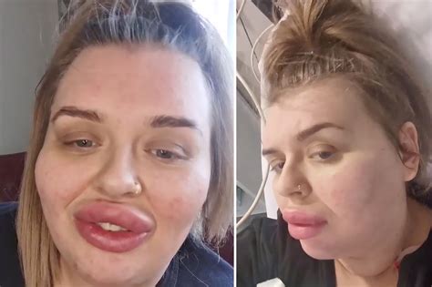 I Was Hospitalized With Baboon Bum Lips After Filler Reaction