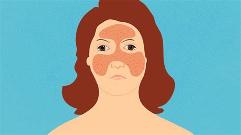 Comment Identifier Les éruptions Et Autres Symptômes Cutanés Du Lupus