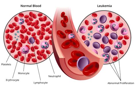 Acute Lymphocytic Leukemia Mbbch Health Encyclopedia