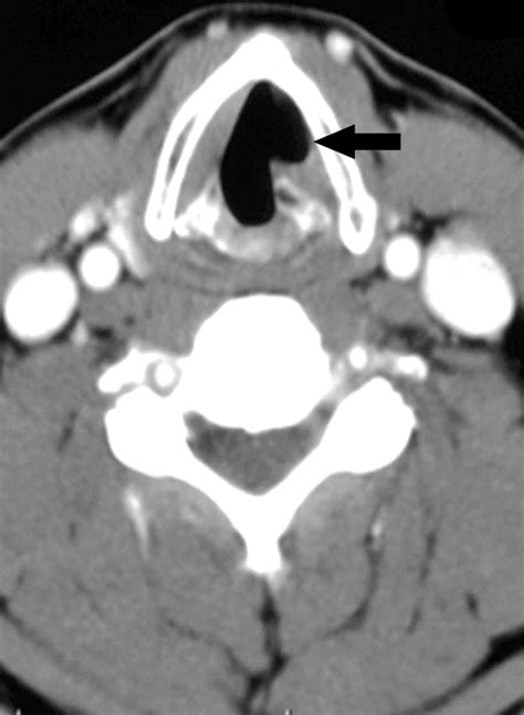 Ct Assessment Of Vocal Cord Medialization American Journal Of