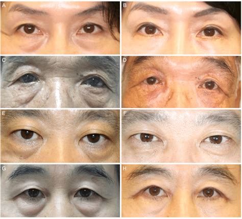 Lower Blepharoplasty Before And After Doctorvisit