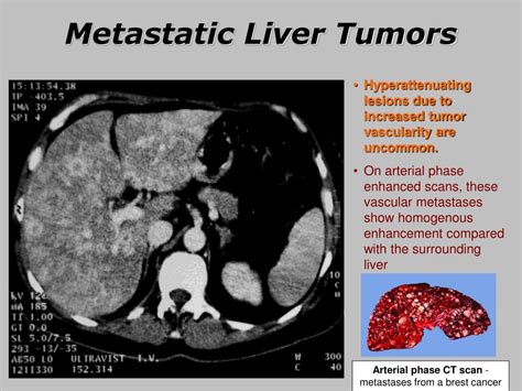 Ppt Liver Cancer Powerpoint Presentation Free Download Id6399378
