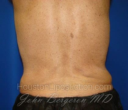 Patient Liposuction Before And After Photos Katy Cosmetic Surgery Gallery Houston Tx