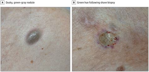Asymptomatic Green Gray Nodules On The Chest Dermatology Jama
