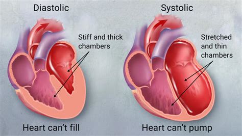 Heart Failure Cardiac Insufficiency Definition Etiology