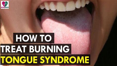 How To Treat Burning Tongue Syndrome Health Sutra Youtube