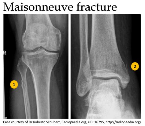 Maisonneuve Fracture Tunequst