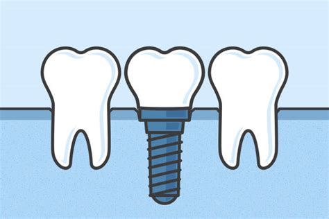 Best Dental Implant Illustrations Royalty Free Vector Graphics And Clip