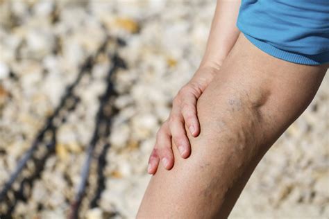 Varicose Veins More Than A Cosmetic Concern Denver Moms