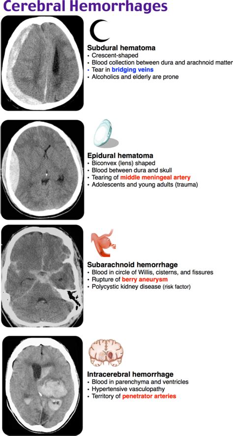 Subdural hematoma vs epidural hematoma. Rosh Review | Medical anatomy, Icu nursing, Medical education