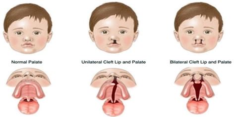 Cleft Lip And Cleft Palate Cause Symptoms And Complications