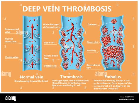 Thrombosis From Normal Blood Flow To Blood Clot Formation And Clot