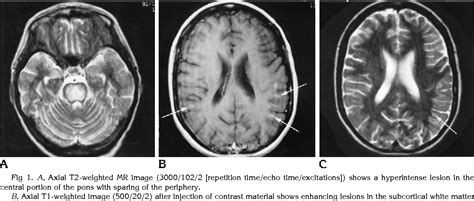 Figure 1 From Subcortical White Matter Lesions In Osmotic Demyelination