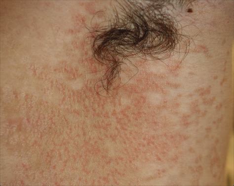 Confluent Scaly Erythematous Plaques On The Trunk Of A 16 Year Old Boy