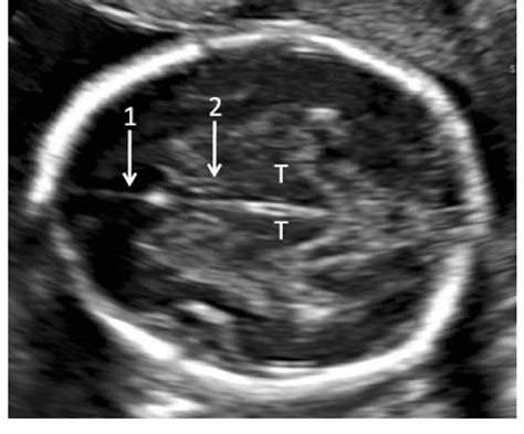 Normal Cavum Septum Pellucidum Ultrasound