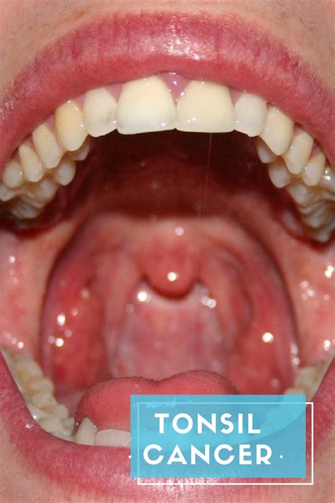 Tonsil Cancer Symptoms Diagnosis And Treatment Thelifesquare My XXX