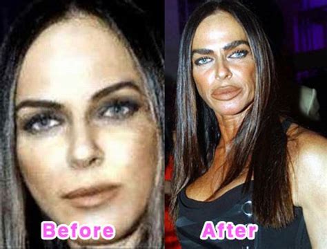 Celebrity Plastic Surgery Disasters Top 15 Most Horrible Celebrity