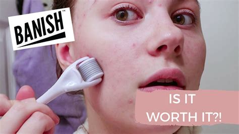 I Tried Banish Acne Scars For 1 Month Is It Worth It Youtube