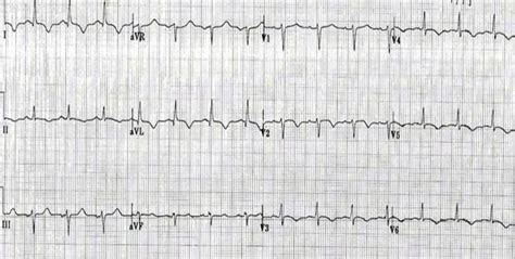 Ecg changes in acute pericarditis, myocarditis, perimyocarditis. Myocarditis electrocardiogram - wikidoc