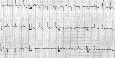 A position statement of the european society of cardiology working group on myocardial and pericardial diseases. Myocarditis electrocardiogram - wikidoc