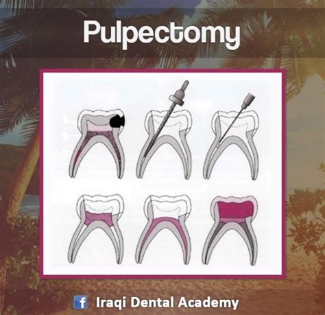 Partial Pulpotomy Procedure