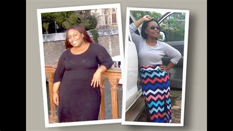 How It Feels Before And After Losing Weight With Gastric Sleeve Surgery