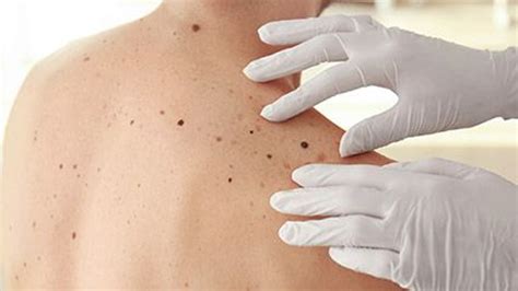 New Treatment Approach Boosts Odds Against 2 Types Of Skin Cancer