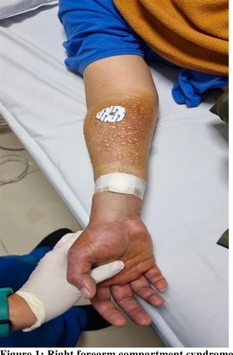 Figure 1 From Forearm Compartment Syndrome Due To Transradial PCI In