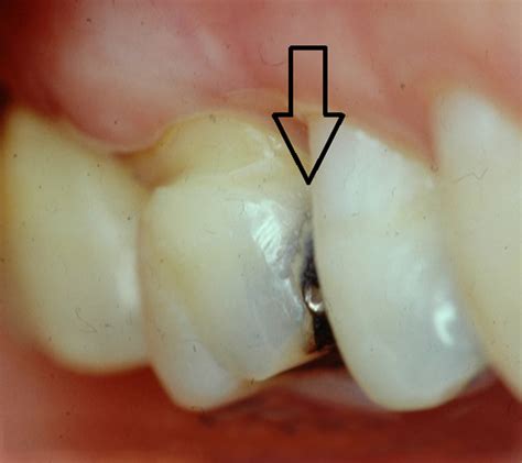 Traditional Class II Tooth Preparation Figure 4 Pre Operative Class II