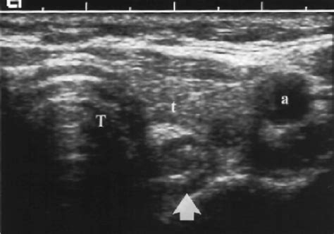 Thyroid Parathyroid And Neck Ultrasound Radiology Key