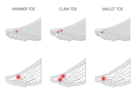 Hammer Toe Causes Symptoms And Treatment Bioskin Bracing