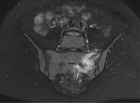 Sneezing: A Rare Cause of Sacral Insufficiency Fracture in ...