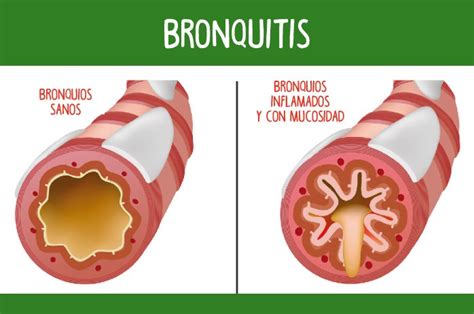 Bronquitis Causas Síntomas Y Tratamiento Meditip