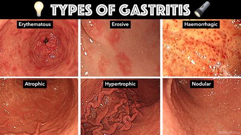 Hemorrhagic Gastritis