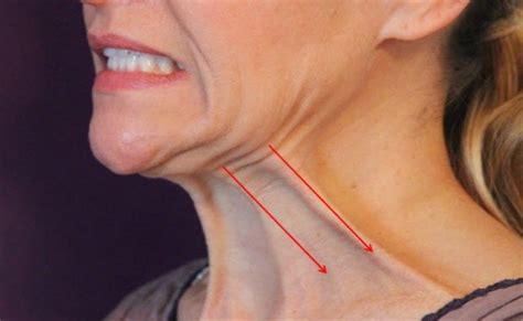 L Shape And Strong Jawlines By Botox Injection With Nefertiti Neck Lift Technique Clinic Neo