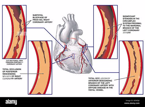 Coronary Artery Disease With Blockage Sites Stock Photo 7711975 Alamy