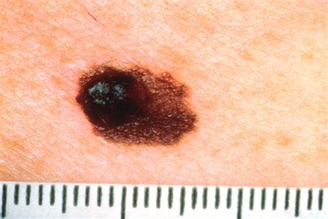 How To Detect Skin Cancer Southern Cancer Center