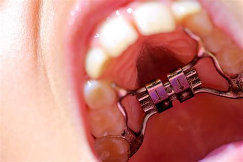 Appareil Dentaire Dudley Smiles Orthodontics