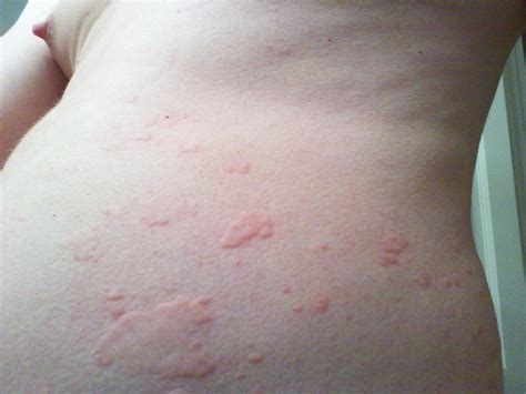 Skin Rash From Detergent Allergic To Detergent Pics Babycenter