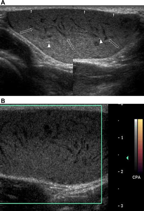 Figure 2 From Giant Epidermal Inclusion Cyst Of The Axilla A Case