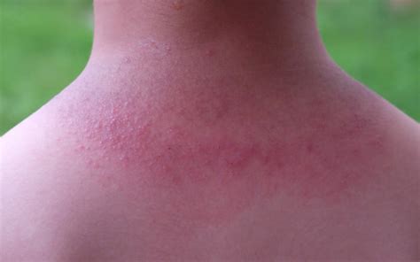 Sun Rash Treatments Symptoms And Causes Skinkraft