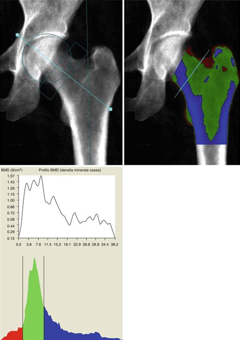 Bone Mineral Density And Quantitative Imaging Radiology Key